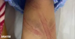 Vụ nữ sinh lớp 7 nghi bị bạo hành