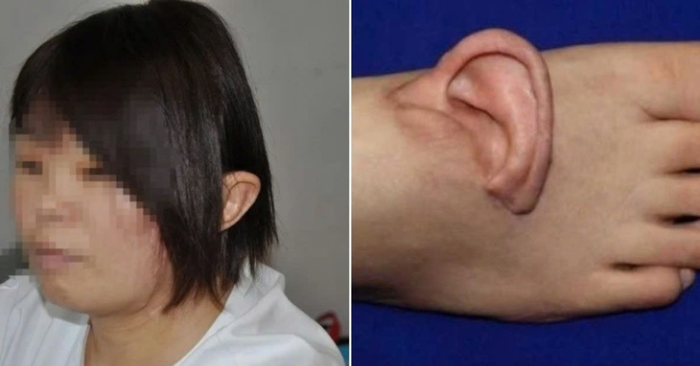  Ghép tai lên bàn chân
