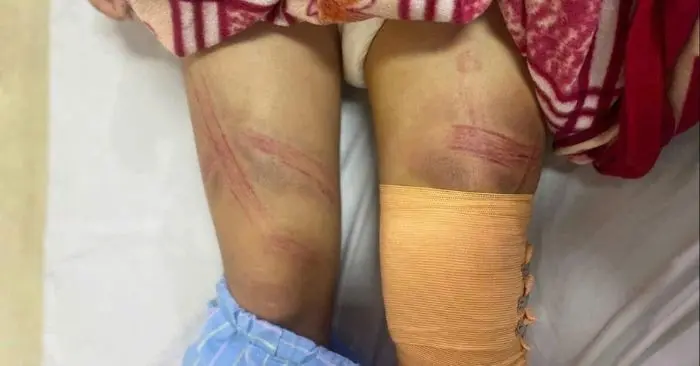 nữ sinh lớp 7 nhập viện với nhiều vết bầm