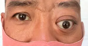 lồi mắt