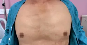 ép tim ngoài lồng ngực