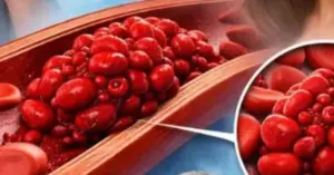 Nhận biết sớm dấu hiệu cục máu đông