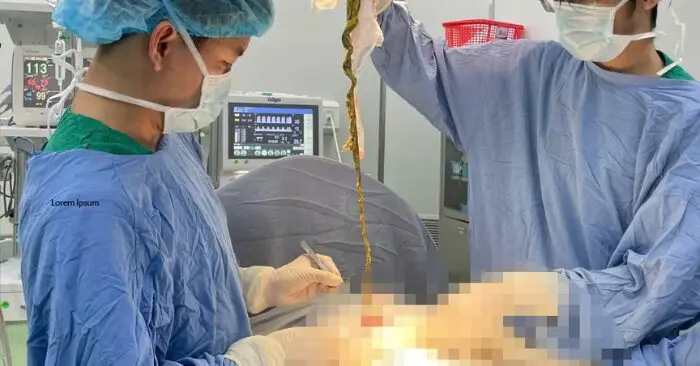 búi tóc trong dạ dày