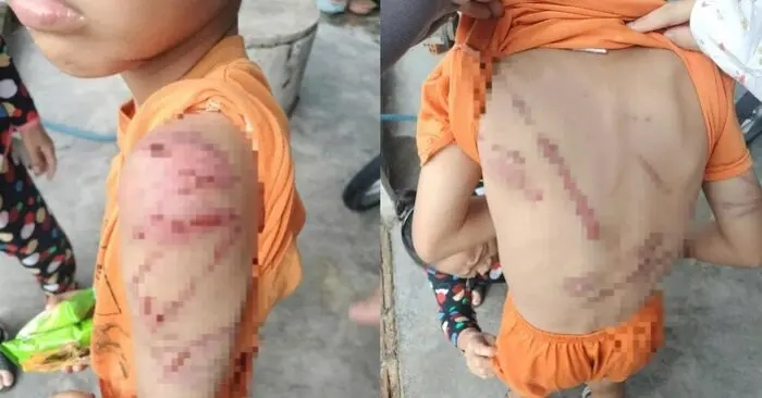 cháu bé nghi bị cha bạo hành