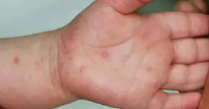 ca mắc tay chân miệng