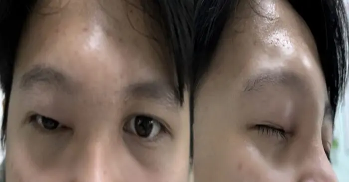hủy xương trán