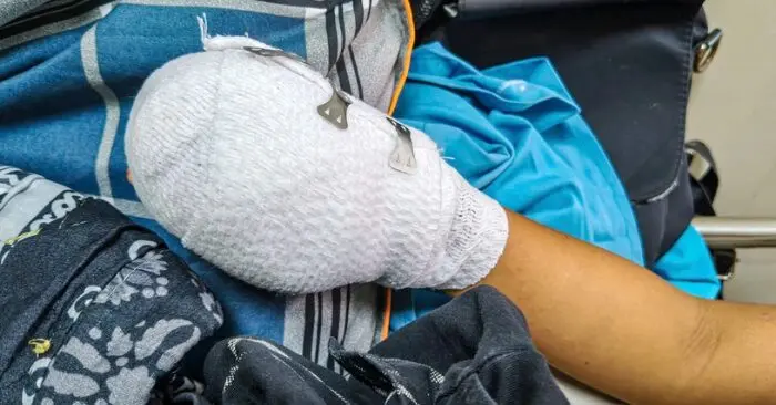 Bé trai 9 tuổi ở Đà Nẵng nát bàn tay nghi vấn điện thoại phát nổ