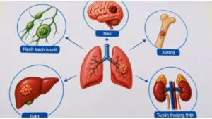Ung thư phổi có thể di căn đến hạch bạch huyết, xương, não, gan và nhiều cơ quan khác. Tìm hiểu dấu hiệu và các vị trí thường gặp.