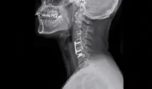 Bệnh thoái hóa đĩa đệm cột sống cổ ngày càng trẻ hóa. Nhận biết dấu hiệu sớm và nguyên nhân nhiều người dễ bỏ qua.