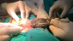 Bác sĩ lấy búi tóc và sợi vải dài gần 20cm trong dạ dày bé trai 46 tháng tuổi, cảnh báo nguy cơ từ thói quen nuốt tóc ở trẻ.