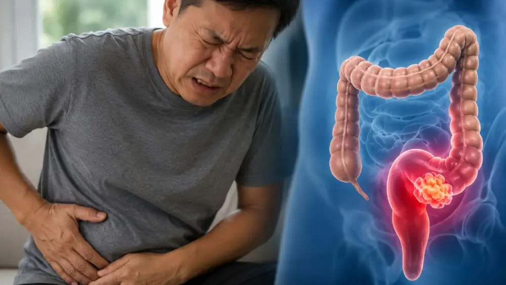 Dấu hiệu sớm ung thư trực tràng dễ bị bỏ qua như thay đổi đại tiện, đầy bụng kéo dài. Nhận biết sớm để chủ động thăm khám.