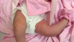 Bé sơ sinh mắc dị tật khớp gối bẩm sinh được Bệnh viện Nhi Hải Phòng điều trị, sức khỏe cải thiện sau 8 ngày.