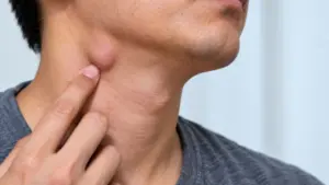 4 dấu hiệu hạch ở cổ bất thường cần lưu ý, từ hạch không nhỏ lại đến phát triển lớn, cứng chắc hoặc kèm triệu chứng bất thường.