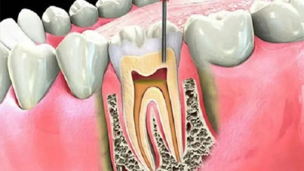 Viêm quanh răng có thể gây tiêu xương ổ răng, lung lay và mất răng. Nhận biết dấu hiệu và cách phòng ngừa bệnh hiệu quả.
